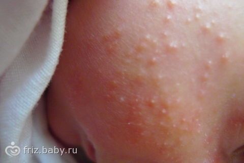 Сыпь в виде папулы на голове Сыпь в виде папулы на голове