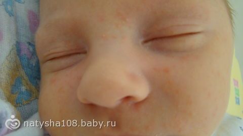 Сыпь на веках с фото Сыпь на веках с фото