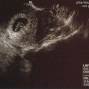 Фотографии УЗИ на 8-й неделе беременности