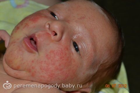Гормональная сыпь у грудничка когда проходит 13