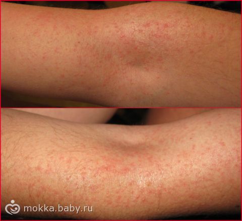 Покраснение и сыпь на руках у ребенка Покраснение и сыпь на руках у ребенка