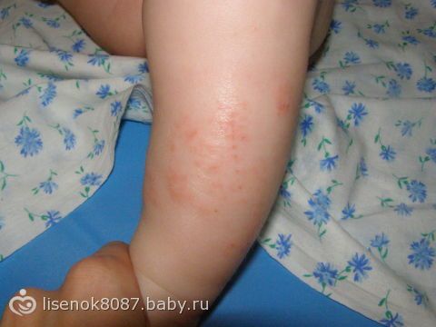 Жесткая сыпь на ногах у ребенка Жесткая сыпь на ногах у ребенка