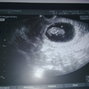 Фотографии УЗИ на 10-й неделе беременности