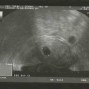 Фотографии УЗИ на 6-й неделе беременности