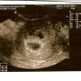 Фотографии УЗИ на 5-й неделе беременности
