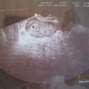 Фотографии полосок на 3-й неделе беременности