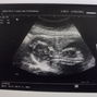 Фотографии УЗИ на 17-й неделе беременности