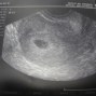 Фотографии УЗИ на 5-й неделе беременности