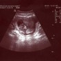 Фотографии УЗИ на 14-й неделе беременности