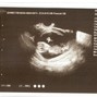 Фотографии УЗИ на 12-й неделе беременности