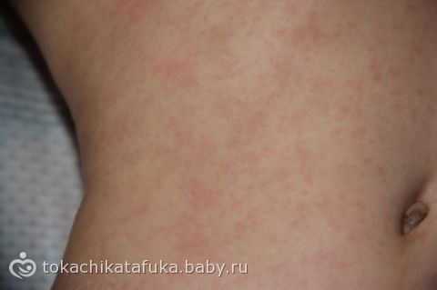 Сыпь на шее при приеме антибиотиков Сыпь на шее при приеме антибиотиков