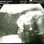 Фотографии УЗИ на 22-й неделе беременности