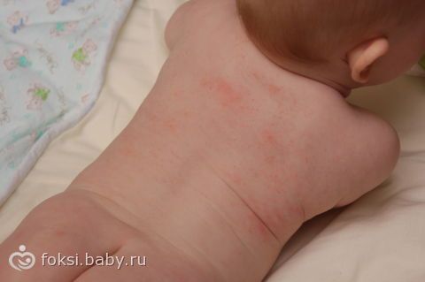 Как выглядит потница у ребенка на спине