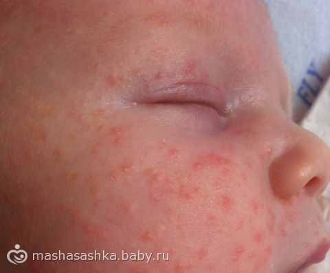 стафилококковая сыпь фото онлайн стафилококковая сыпь фото