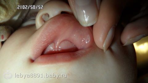 фото молочница детская во рту онлайн фото молочница детская во рту